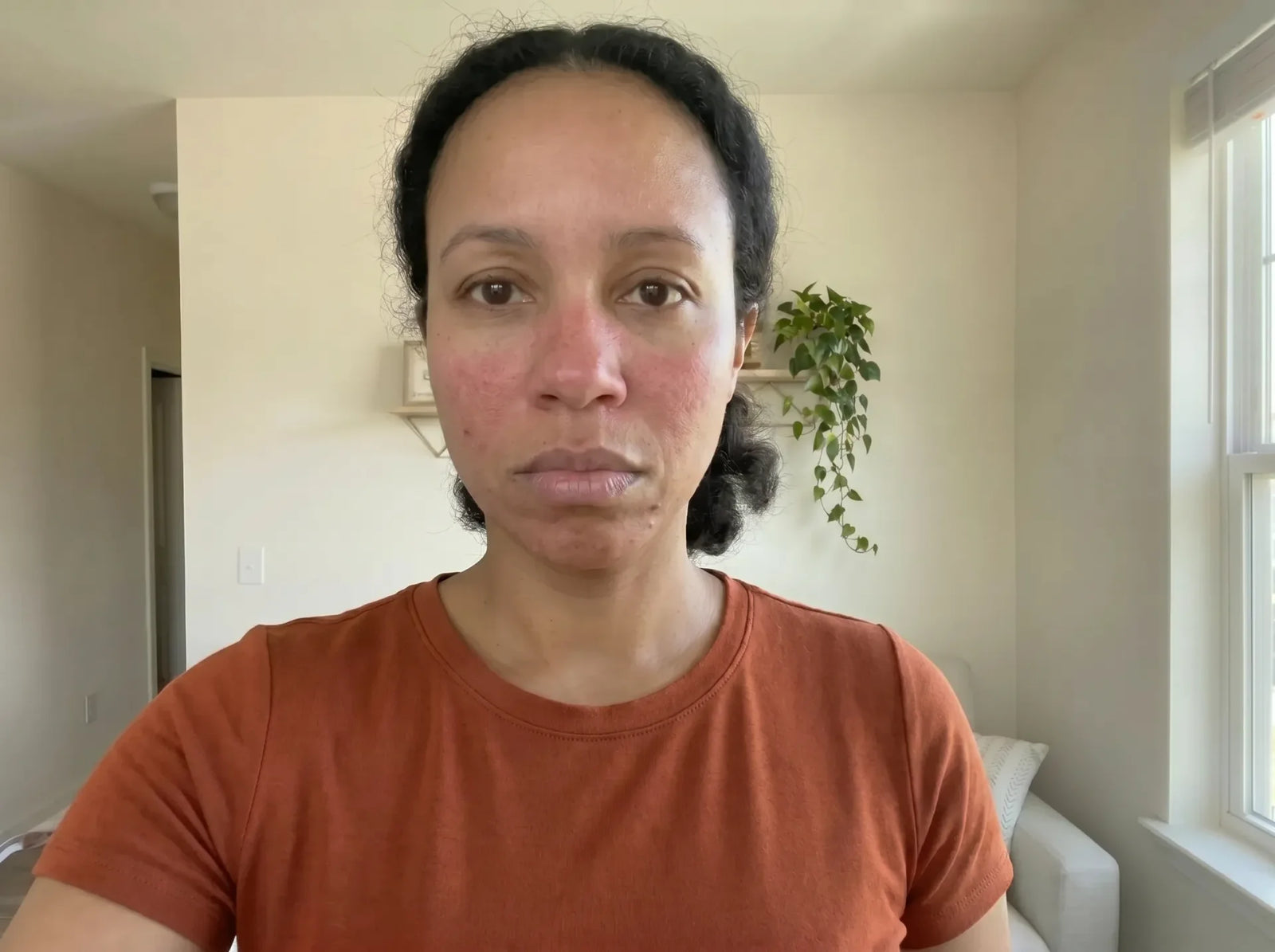 Close-up of a woman's face showing redness and flushing across the cheeks and nose before using Polynae skincare